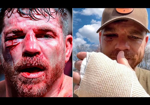 23 Шва, Два перелома». Миллер - О Последствиях Боя с Грином.